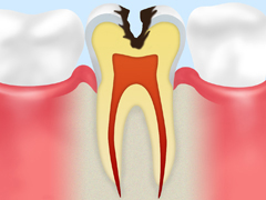 C2～象牙質の虫歯～