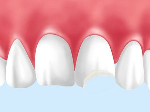 歯の外傷